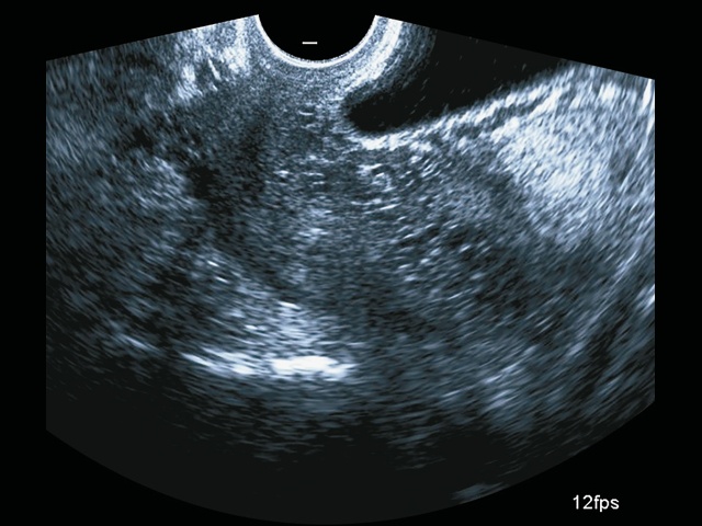 Эхограмма (B-режим): ретроплацентарные лакуны в шейке матки (беременность 28+6 нед)