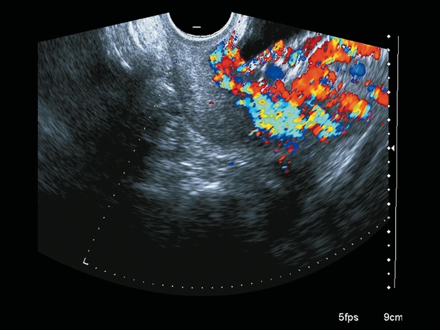 Эхограмма (режим ЦДК): васкулярная инвазия в шейку матки (беременность 28+6 нед)