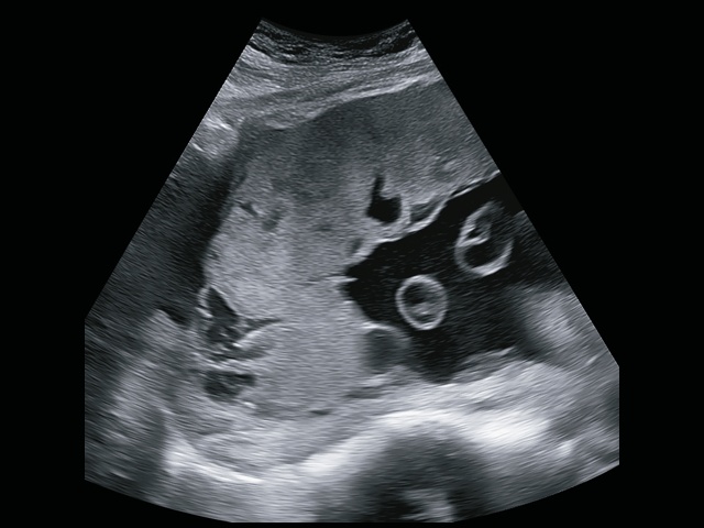 Эхограмма (B-режим): ретроплацентарные лакуны, отсутствие нормальной гипоэхогенной ретроплацентарной зоны, истончение миометрия, выпячивание плаценты (беременность 32+4 нед)