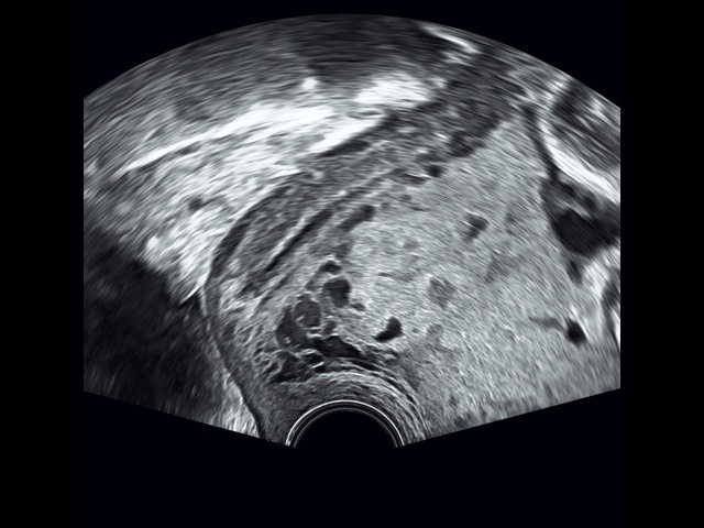 Трансвагинальное сканирование (B-режим): ретроплацентарные лакуны в шейке матки и цервикальном канале (беременность 32+4 нед)