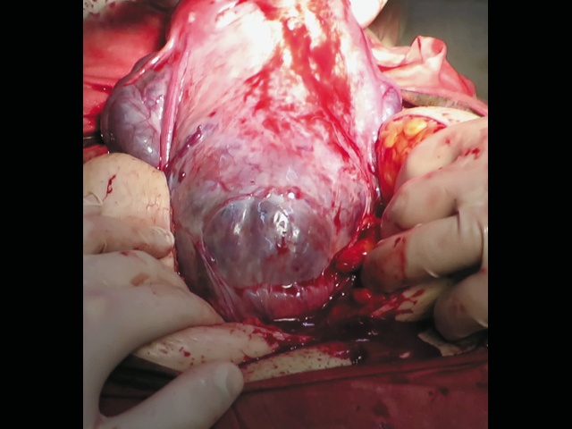 Интраоперационный вид: placenta percreta (PAS 3b)