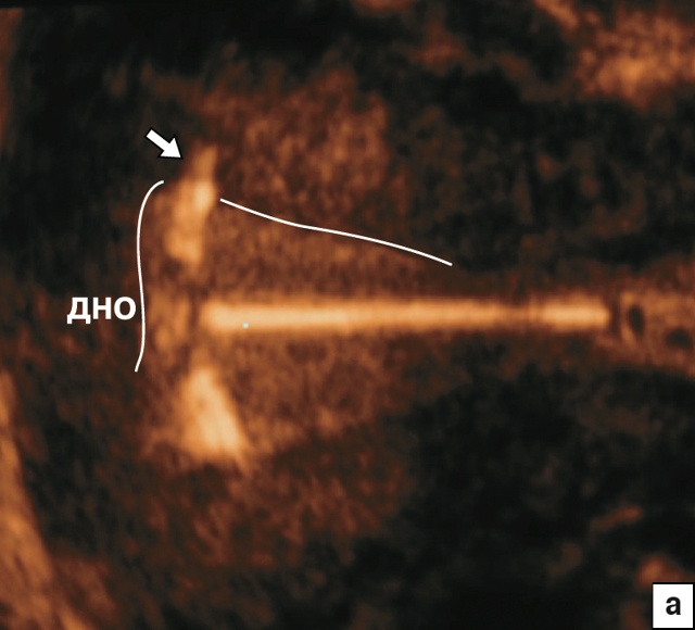 Эхографическая картина пенетрации плечиков Т-образных ВМС в миометрий, корональный срез (а)