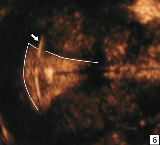 Эхографическая картина пенетрации плечиков Т-образных ВМС в миометрий, корональный срез (б)