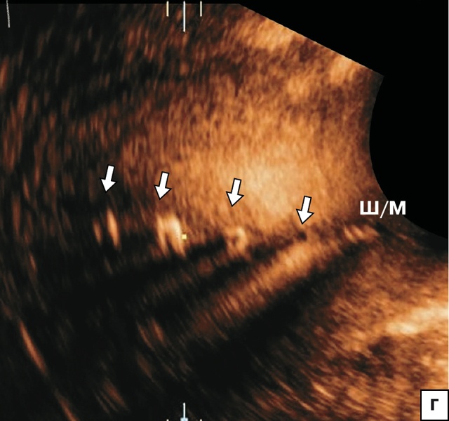 Эхографическая картина петли Липпеса в проекции полости матки в виде линейно расположенных 4–5 эхогенных фрагментов (стрелки)