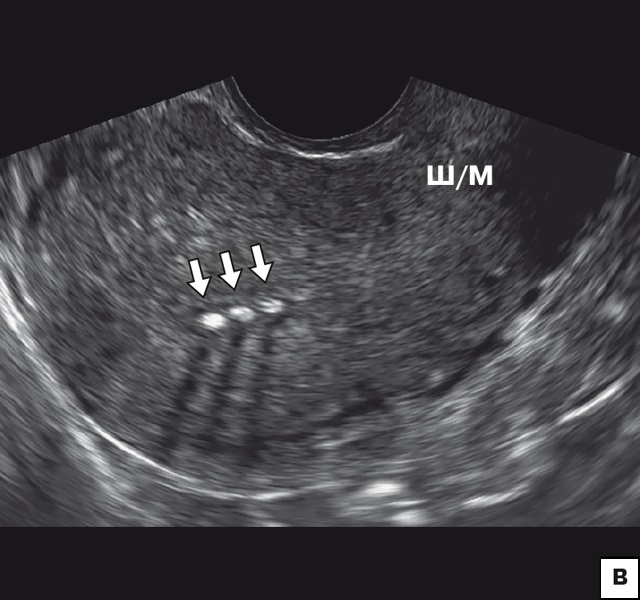 Эхографическая картина изогнутых плечиков Multiload в виде гиперэхогенных фрагментов в проекции полости матки (стрелки)