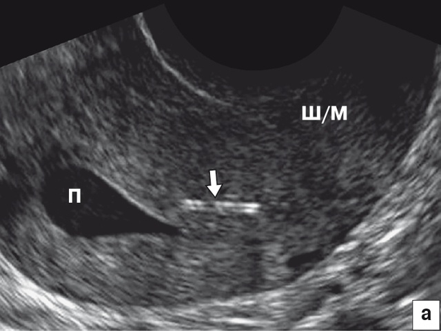 Эхографическая картина стержня ВМС в миометрии