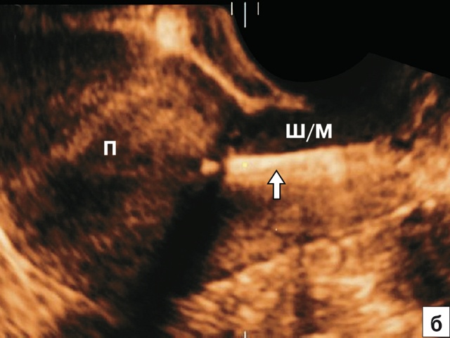 Эхографическая картина стержня ВМС в шейке матки