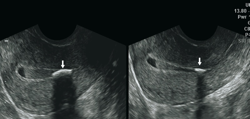 Эхограмма матки - стрелки показывают фрагмент кости плода в расширенной полости после прерывания беременности