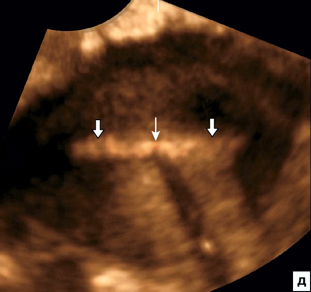 Эхографическая картина ВМС Мирена не дает четкого отражения от плечиков (стрелки), тонкая стрелка – тень от стержня (поперечный срез на уровне дна полости матки)