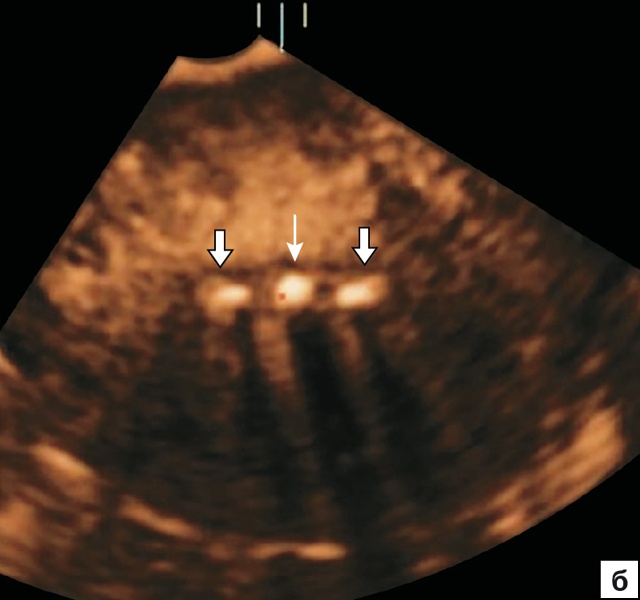 Эхографическая картина ВМС Multiload: тонкая стрелка - стержень, крупные стрелки - боковые фрагменты (поперечный срез матки)
