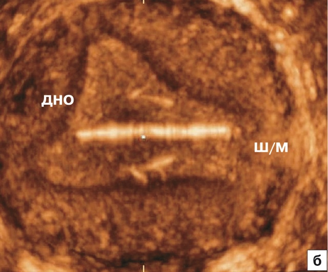 Эхографическая картина поворота ВМС Multiload относительно продольной оси матки (корональный срез)