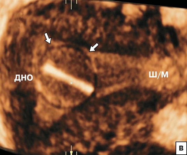 Эхографическая картина поворота кольцеобразной (стрелки) ВМС относительно продольной оси матки (корональный срез)