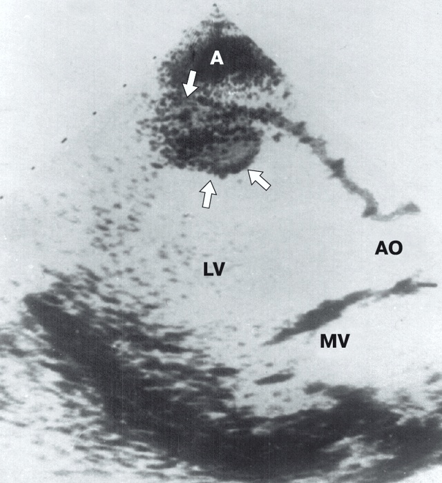 Эхограмма - тромб (стрелки) в области верхушки (А) левого желудочка (LV), AO – аорта, MV – митральный клапан