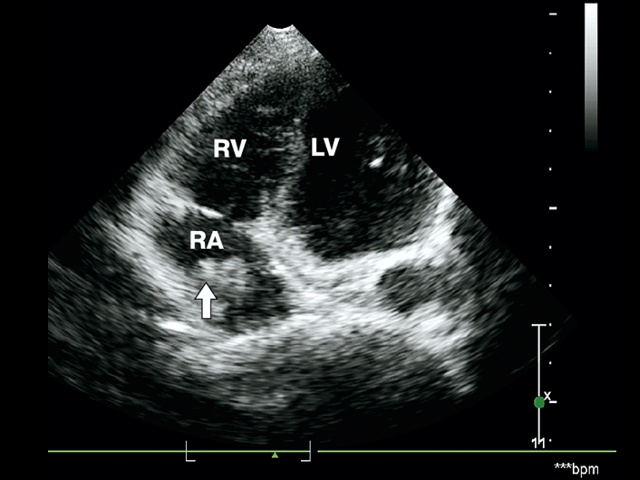 Эхограмма - большой тромб (стрелка) в правом предсердии (RA), RV – правый желудочек, LV – левый желудочек