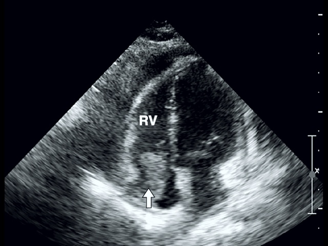 Эхограмма - большой тромб (стрелка), пролабирующий в полость правого желудочка (RV)