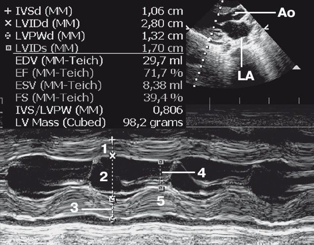 Эхограмма - тромб (стрелки) в области верхушки (А) левого желудочка (LV), AO – аорта, MV – митральный клапан