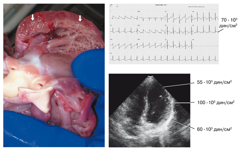 Эхографические, электрокардиографические и морфологические проявления ишемии миокарда