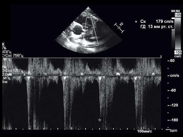 Эхограмма - парастернальная проекция по короткой оси аортального клапана (импульсноволновой режим, градиент давления на клапане легочной артерии 13,0 мм рт.ст.)