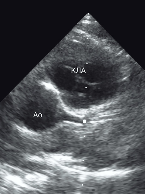 Эхограмма - модифицированная парастернальная проекция с визуализацией клапана легочной артерии по короткой оси (В-режим, Ао – аорта, КЛА – клапан легочной артерии)