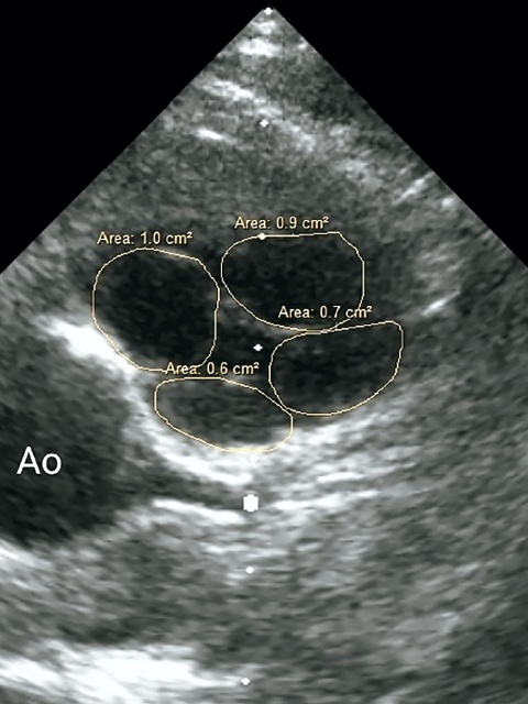 Эхограмма - модифицированная парастернальная проекция с визуализацией клапана легочной артерии по короткой оси (В-режим, оценка площадей четырех створок клапана легочной артерии, Ао – аорта)