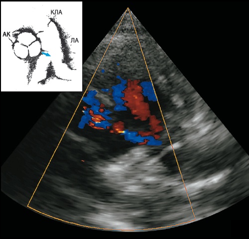 Эхограмма - коронарная фистула в проекции основания правой легочной артерии (5а)