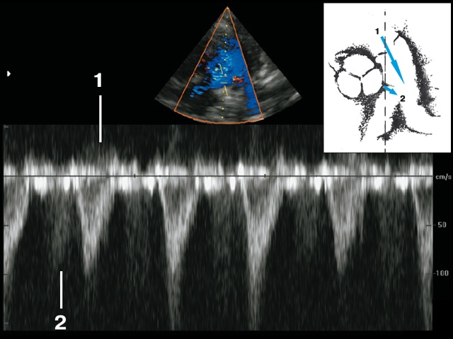 Эхограмма - коронарная фистула в проекции основания правой легочной артерии (5в)