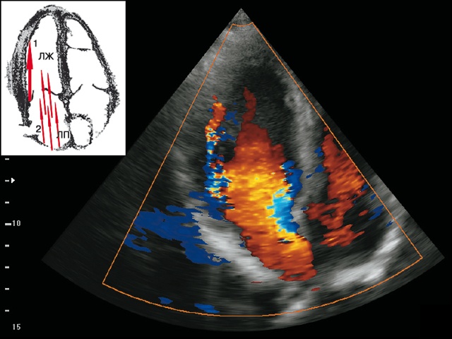 Эхограмма - коронарная фистула (6а)