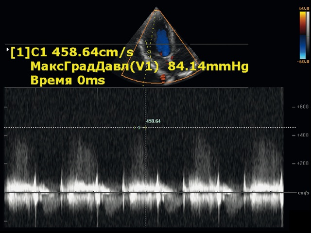 Эхограмма - коронарная фистула (6б)