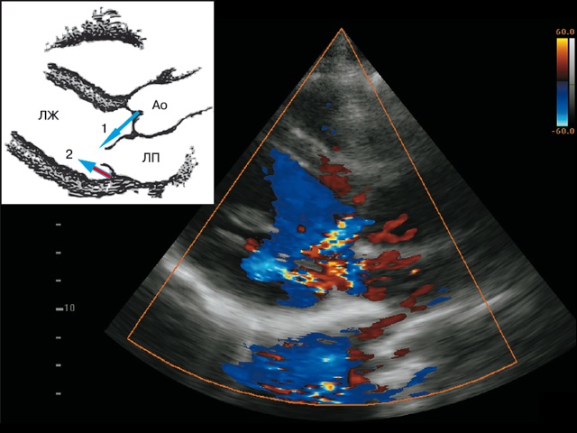 Эхограмма - коронарная фистула (6в)