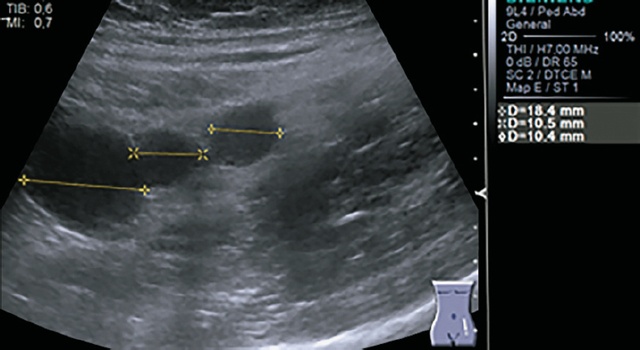 Эхограмма - образования в левом мезогастрии, спленоз (B-режим)