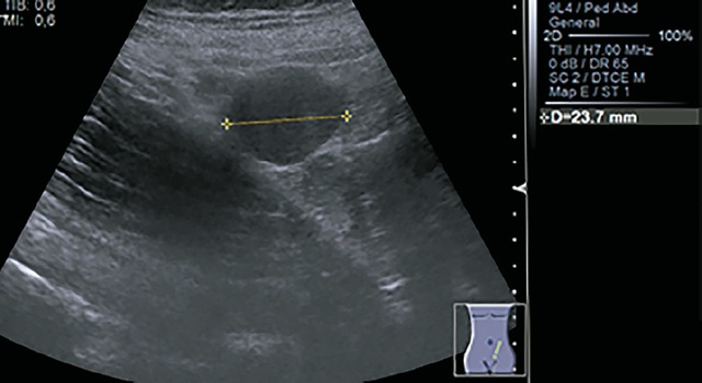Эхограмма - образование в левой подвздошной области, спленоз (B-режим)