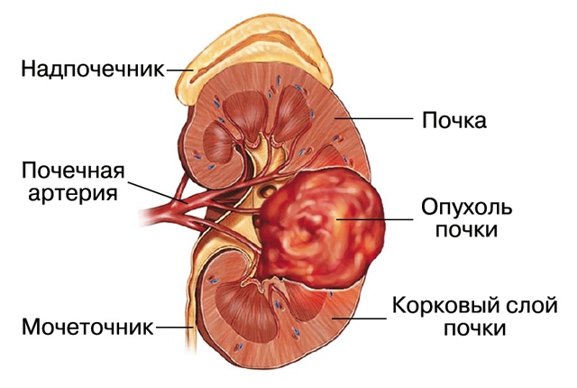 Рисунок - ангиомиолипома почки