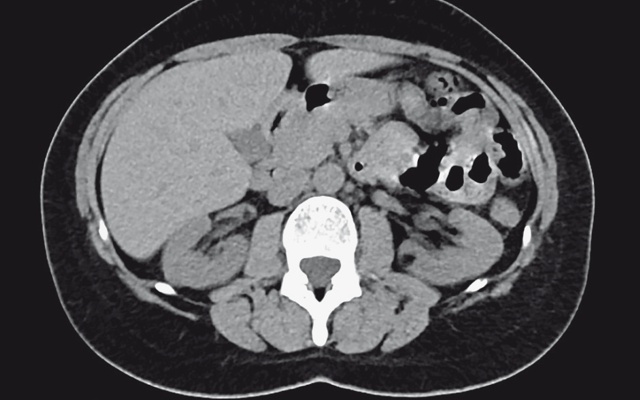 КТ ангиомиолипомы почки (нативная фаза) - пациентка С