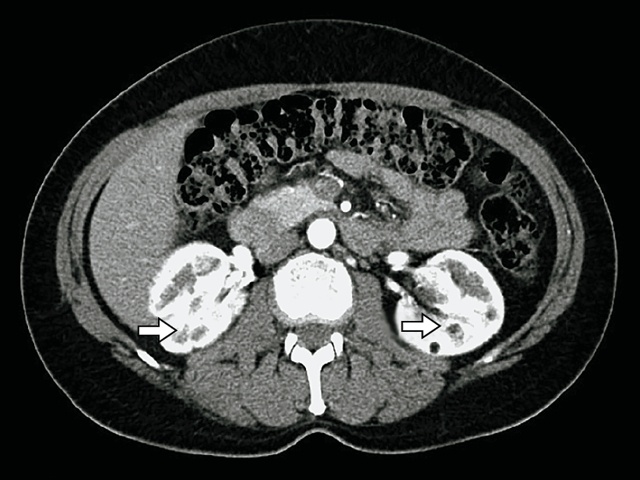 КТ ангиомиолипомы почки (артериальная фаза) - пациентка Д, 47 лет