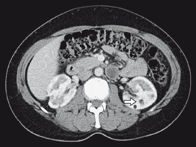 КТ ангиомиолипомы почки (венозная фаза) - пациентка Д, 47 лет