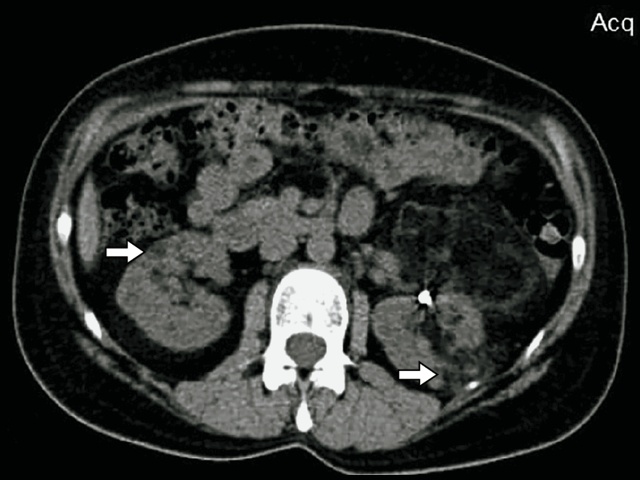 КТ почки после селективной эмболизации артерии  (нативная фаза) - пациентка П, 39 лет