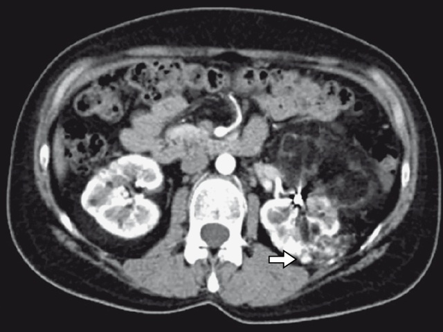 КТ почки после селективной эмболизации артерии  (артериальная фаза) - пациентка П, 39 лет