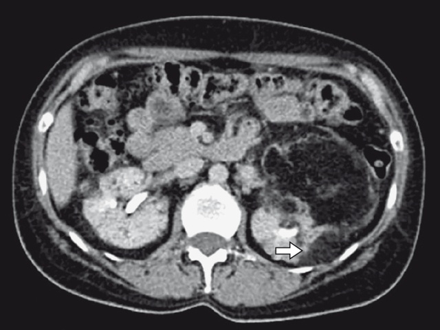 КТ почки после селективной эмболизации артерии (венозная фаза) - пациентка П, 39 лет