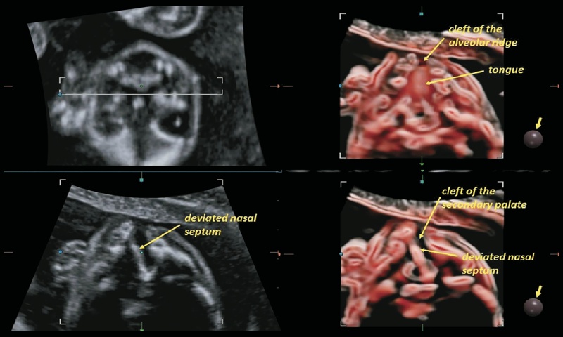 Эхограмма плода на 21-й неделе с расщелиной, затрагивающей альвеолярный отросток и вторичное твердое нёбо (аксиальная проекция, режим CrystalVue™ и RealisticVue™)