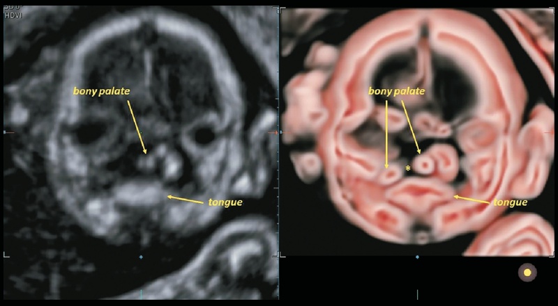 Эхограмма плода на 21-й неделе с расщелиной, затрагивающей альвеолярный отросток и вторичное твердое нёбо (коронарная проекция, режим CrystalVue™ и RealisticVue™)