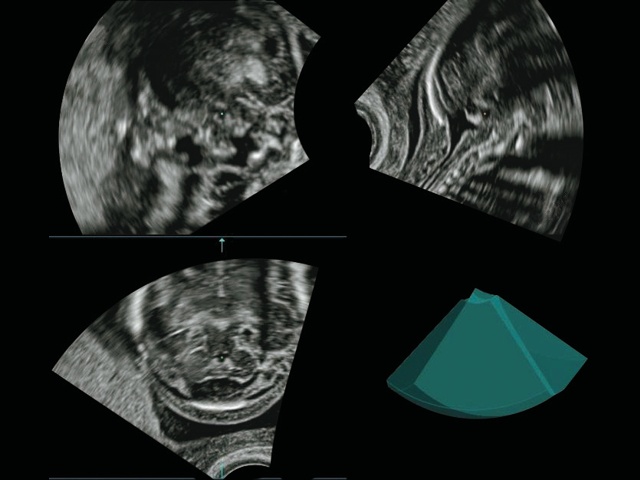 Эхограмма задней черепной ямки плода - полутоновое мультипланарное изображение