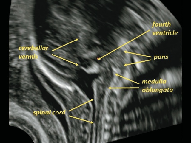 Эхограмма задней черепной ямки плода - срединное сагиттальное изображение (червь мозжечка, IV желудочек, мост, продолговатый мозг и проксимальная часть шейного отдела позвоночника)
