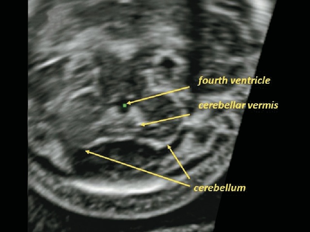 Эхограмма задней черепной ямки плода - аксиальное изображение (IV желудочек, червь мозжечка и полушария)