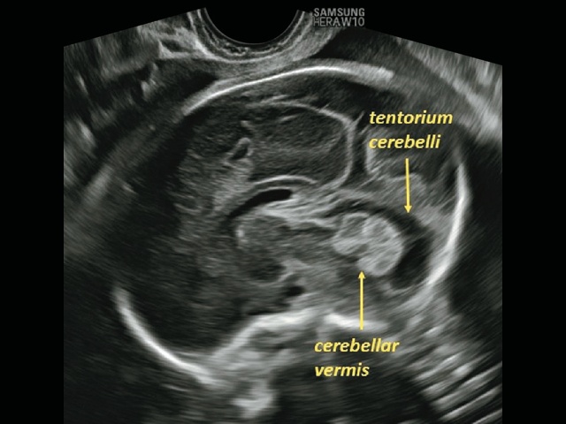 Эхограмма червя мозжечка и намета мозжечка у плода (ТВУЗИ в срединной сагиттальной плоскости через сагиттальный шов)