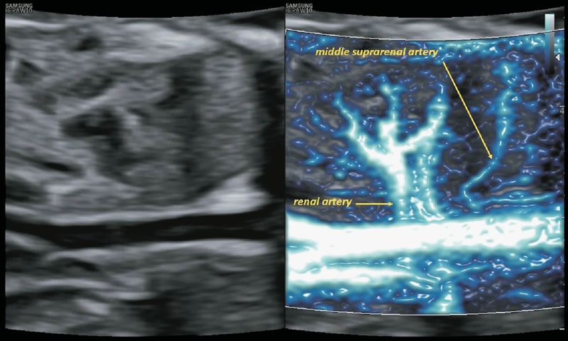 Двойное динамическое отображение брюшной полости плода в коронарной проекции (режим MV-Flow™ и LumiFlow™, Middle suprarenal artery – средняя надпочечниковая артерия, renal artery – почечная артерия)