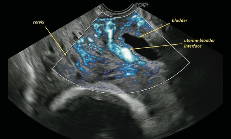 Эхограмма аномальной васкуляризации шейки матки и границы между маткой и мочевым пузырем (режим MV-Flow™ и LumiFlow™)