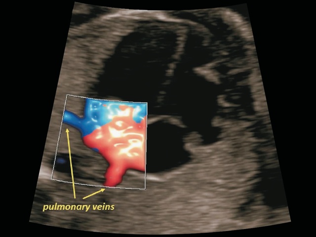 Эхограмма легочных вен плода, несущих кровь в левое предсердие (режим энергетического допплера)