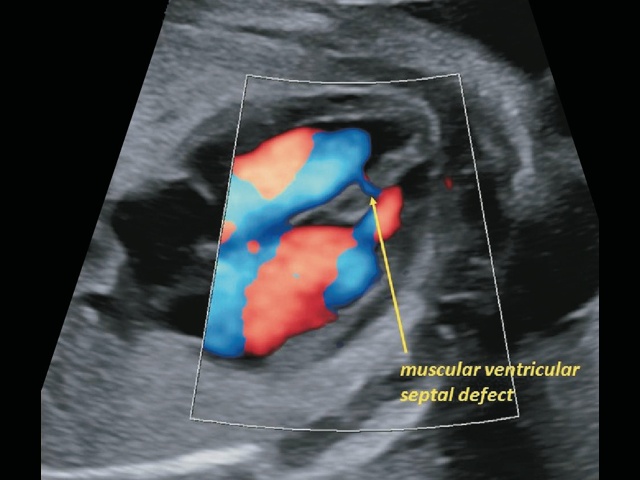 Эхограмма дефекта межжелудочковой перегородки у плода (режим энергетического допплера)