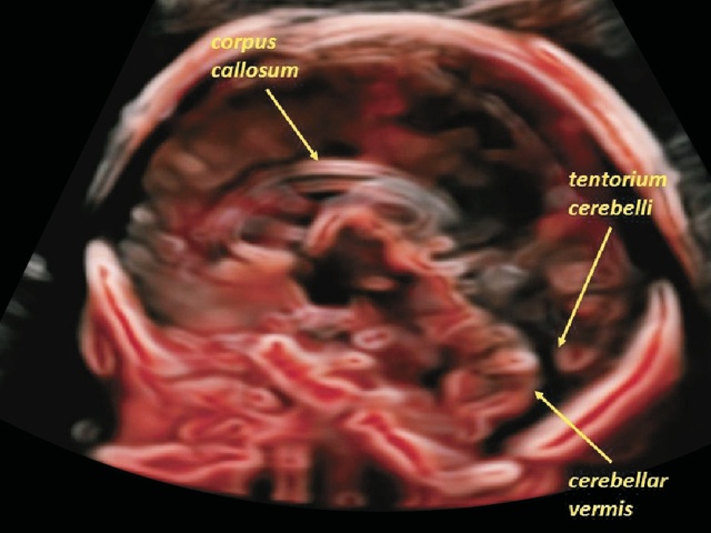 Эхограмма головного мозга плода - срединная сагиттальная проекция (режим CrustalVue™)