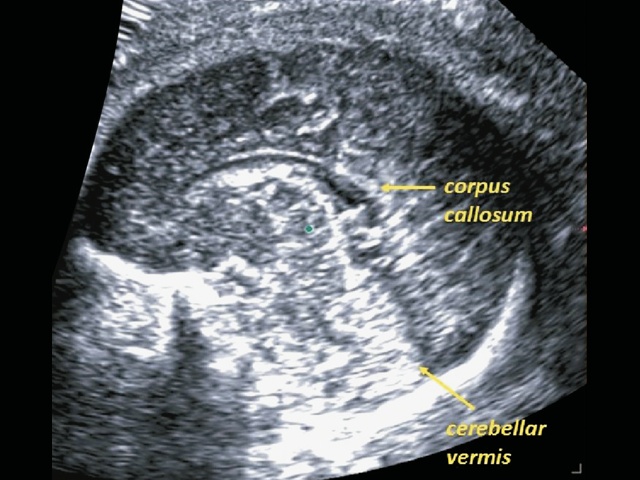 Эхограмма головного мозга плода - срединная сагиттальная проекция (B-режим)